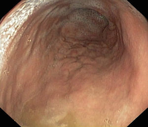 Upper gastrointestinal endoscopy.