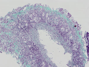 Gastric biopsy.