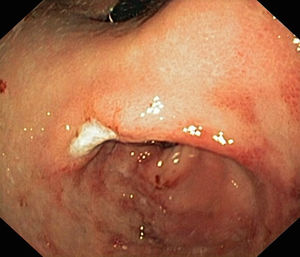 Oedema and erosion of gastric mucosa with pyloric stenosis and ulcer in the angular notch.