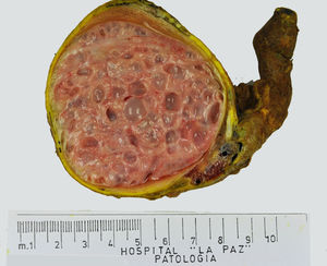 Gross photograph of a postpubertal-type teratoma in a patient aged 16 years. Numerous cysts replace most of the parenchyma.