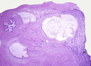 Micrograph of a prepubertal-type teratoma with organoid arrangement. Note the cysts sheathed by glandular mucosal lining and surrounded by smooth muscle. On the side, prepubertal testicular parenchyma without germ cell neoplasia in situ.