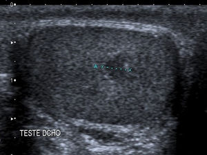 Chance finding on ultrasound of the right testis of a solid nodule 4.5mm in diameter with hyperechoic edge and changes in echogenicity in the surrounding area.
