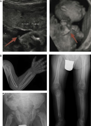 Characteristic findings of imaging tests in cases of perinatal lethal hypophosphatasia (a) and infantile hypophosphatasia (b). (a) Ultrasound at 18 weeks’ gestation: bone spurs in right knew and right elbow (3D). (b) Radiologic evaluation in patient aged 17 months: marked changes in long bone methaphyses (proximal metaphyses of both humeri, distal metaphyses of both radii and ulnae, and proximal metaphyses of both femora, tibiae and fibulae), with metaphyseal flaring, reduced bone density, thickened trabeculae and radiolucent projections that extend from physis to metaphysis. Linear periosteal reaction in the left radius. Images reproduced with the authorization of Zankl A, Mornet E, Wong S. Specific ultrasonography features of perinatal lethal hypophosphatasia. Am J Med Gen Part A. 2008;146A:1200–1204, and Caballero Mora FJ, Martos Moreno GA, García Esparza E, Argente J. Hipofosfatasia infantil. An Pediatr. 2012;76:368–369.