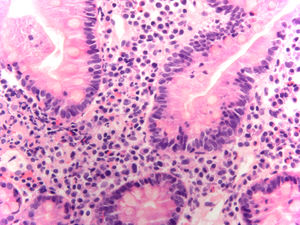 Microscopic image of duodenal mucosa. Significant mixed inflammatory cell infiltrate with eosinophils. HE stain. 400× magnification.