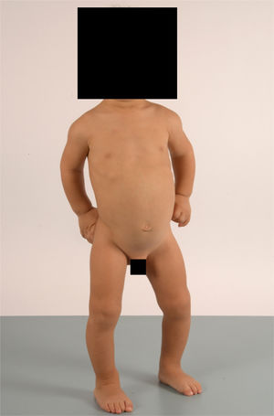 Boy aged 2 years (case 1) with short stature, brachydactyly with rhizomelia and genu varum.