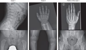 Cases 1 and 2: anterior beaking in vertebral bodies; shortened and irregular carpals and metacarpals, phalanges with cone-shaped epiphyses; irregularities in long bones, femoral head and acetabulum. Father of case 1: normal findings in hand and hip radiographs.