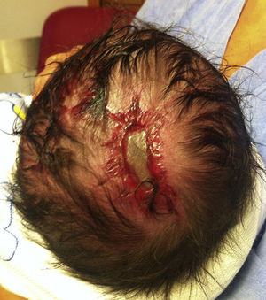 Male neonate with single ACC lesion of the scalp.