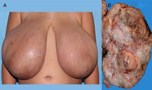 (A) Image of the abnormal breasts. (B) Gross appearance of the surgical specimen.