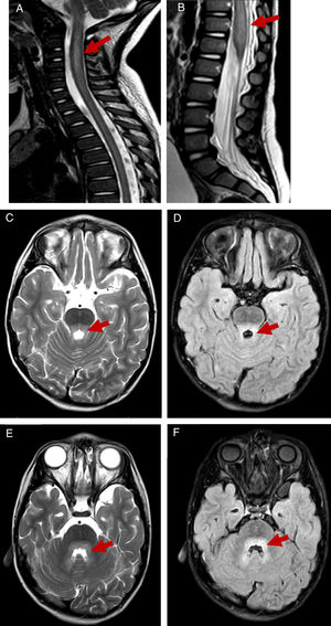 T2-weighted and FLAIR MR images showing hindbrain involvement with myelitis. T2-weighed images showing hyperintensity on at the level of the cervical spine until segment C6 in patient 2 (A) and significant thickening of the conus medullaris in patient 4 (B). Hyperintensity on T2-weighted and FLAIR MR images at the level of the posterior pons and surrounding the fourth ventricle in patient 2 (C–F).