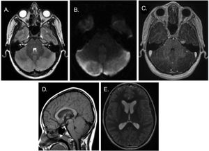 Head MRI. (A) T2-weighted axial plane: hyperintensity and swelling in both cerebellar hemispheres. (B) Generalised restricted diffusion. (C) T1-weighted axial view: absence of enhancement after administration of gadolinium contrast. (D) T1-weighted sagittal view: descent of cerebellar tonsils into foramen magnum, anterior displacement of the brainstem and mild caudal compression of the cerebral aqueduct and the fourth ventricle. (E) Secondary supratentorial ventricular dilation.
