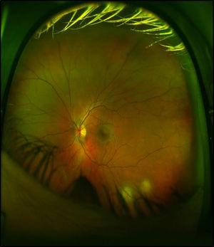 Fundoscopy demonstratring two granulomatous lessions on the lower archade
