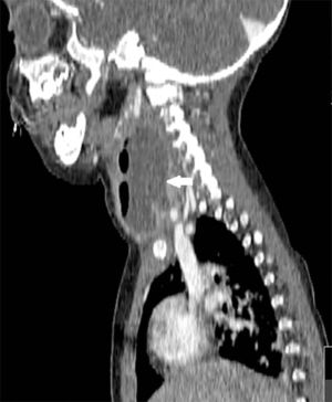 CT scan of retropharyngeal abscess. Sagittal plane.