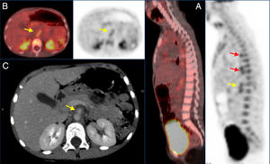 PET/CT and CT images. (A) Sagittal PET/CT and CT views showing increased tracer uptake in the walls of the thoracic aorta (red arrows) and superior mesenteric artery (yellow arrow). (B) Axial PET/CT and CT views showing increased uptake in the walls of the superior mesenteric artery with a SUVmax of 4.03 (yellow arrows). (C) Axial CT view showing thinning of the walls of the proximal segment of the superior mesenteric artery (yellow arrow).
