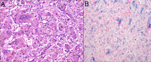 (A) Haematoxylin–eosin stain. Giant cell hepatitis with extensive fibrosis and cholestasis. (B) Perls’ Prussian blue. Iron deposition in the liver.