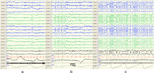 Changes in EEG patterns. Example of portions of an EEG recording during naptime in a patient while awake (a), in REM sleep (b) and non-REM sleep (c). Presence of synchronic and continuous spike and wave discharges on both hemispheres compatible with CSWS during non-REM sleep. The horizontal line drawn at the bottom shows the length equivalent to 1s. EEG machine settings: sensitivity 10μV/mm; HF 70Hz; TC 0.3.