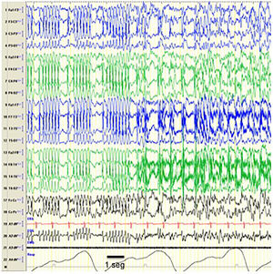 Seizure during CSWS. Tracings showing an episode compatible with an epileptic seizure with a change in the pattern, which is replaced by bilateral spike-wave discharges that are more irregular compared to the previously recorded pattern, suggesting that CSWS is an interseizure pattern that is altered by the development of epileptic seizures. From a clinical standpoint, the seizure manifested with repetitive blinking and jerking movements of the peribuccal muscles. The horizontal line drawn at the bottom shows the length equivalent to 1 second. EEG machine settings: sensitivity 10μV/mm; HF 70Hz; TC 0.3.