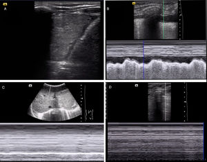 Diagnosis of different respiratory diseases by means of PoCUS. (A) Lung consolidation associated with pleural effusion. (B) Identification of pleural effusion on M-mode (sinusoid sign). (C) Evaluation of diaphragm motion in M-mode, with absence of diaphragmatic excursion (compatible with diaphragm paresis). (D) Absence of lung sliding in M-mode, suggestive of pneumothorax (stratosphere/barcode sign).