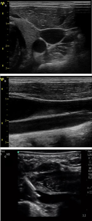 Exploration of cervical vessels by means of PoCUS. (A) Transversal view of vessels, with identification of carotid artery as a round hypoechoic structure and the jugular vein as an oval, more superficial hypoechoic structure. (B) Longitudinal view of the vessels, with identification of jugular vein in a more superficial level and the carotid artery in a deeper level. (C) Subclavian vein cannulation in a newborn infant with a long-axis/in-plane approach.
