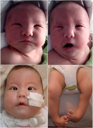 Newborn with bilateral facial palsy at rest (A) and during crying (B): (A) incomplete closure of eyelids (lagophthalmos). (B) Evident facial asymmetry during crying. “Mask face” with partial conservation of function of right inferior facial musculature (deviation of homolateral corner of the mouth). (C) Same patient featured in A and B at age 3 months with nasogastric and a tracheostomy tubes. Evidence of esotropia and low position of the ears. (D) Bilateral clubfoot.