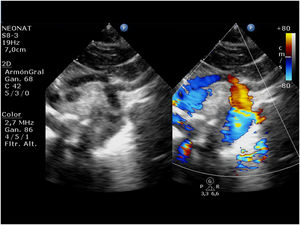 Preoperative echocardiogram in a newborn with hypoplastic left heart syndrome. Note the retrograde flow into the aortic arch and ascending aorta.