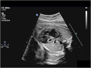 Prenatal echocardiogram at 31 weeks of gestation revealing a severely underdeveloped left ventricle.