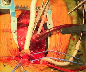 Intraoperative image of a Norwood surgery for stage I palliation in a hypoplastic left heart syndrome patient. An anastomosis between a ring-reinforced 5 mm shunt augmented with heterologous pericardium and the pulmonary artery bifurcation is being performed. The native pulmonary arteries are encircled with blue vessel loops. Note that the arterial inflow is provided through a 3.5 mm shunt anastomosed to the innominate artery while a single venous catheter is placed in the right atrium through its appendix. At this point the patient is being cooled and under cardiopulmonary bypass with continuous flow.