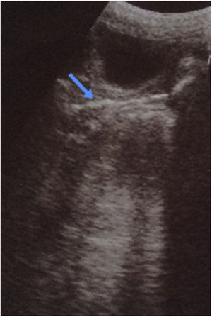 Pelvic ultrasound image showing a hyperechoic linear structure in the vaginal lumen (blue arrow).