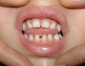 Conical teeth (case 11).
