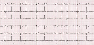Electrocardiogram of case 1.