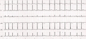 Electrocardiogram of case 2.
