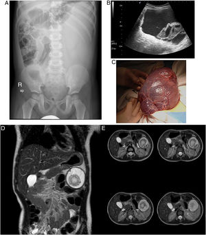 (A–C) Radiological and surgical findings in case A. (A) Abdominal X-ray with the patient in the supine position revealing a mass effect in the left abdomen with displacement of intestinal loops toward the right abdomen. No signs of bowel obstruction. (B) High-resolution grayscale ultrasound image revealing a cystic lesion with echogenic contents, internal septa and another pseudosolid lesion within. (C) Intraoperative image revealing a very large (15×9×3cm) multicystic mass pink in color. (D and E) Radiological findings in case B. Multiphasic contrast-enhanced MRI images in the coronal (D) and axial (E) planes following intravenous administration of gadolinium. Round lesion measuring approximately 5.3cm along all 3 axes located in the left hypochondrium with contents of probable hemorrhagic origin demarcated by a hypointense shape of a capsule or pseudocapsule. No evidence of organ dependence, edema or infiltration of adjacent structures.