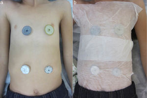 (a) Photograph of the anterior region of the thorax and the abdomen demonstrating the lack of cutaneous reactions after contact with different percutaneous ASD closure devices: Amplatzer Septal Occluder (top left); Figulla ASD Occluder (top right); Cardia Ultrasept (bottom left) and Gore Septal Occluder (bottom right). (b) Photograph illustrating the method used to affix the devices to the skin.