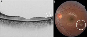 A) Image obtained by OCT showing hypertrophy of the retinal pigment epithelium and absence of the retinal layered structure. Hyperreflective stalagmite-like preretinal deposits (arrow). B) Photograph of the eye fundus showing a typical chorioretinal scar (circle).