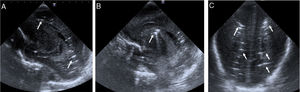 Ultrasound sagittal (A and B) and coronal (C) views showing multiple hyperechoic, birefringent spots and lines in the deep periventricular white matter on both sides of the brain (arrows in A and C) and right caudothalamic groove (arrow in B) that could be attributed to cerebral air embolism.