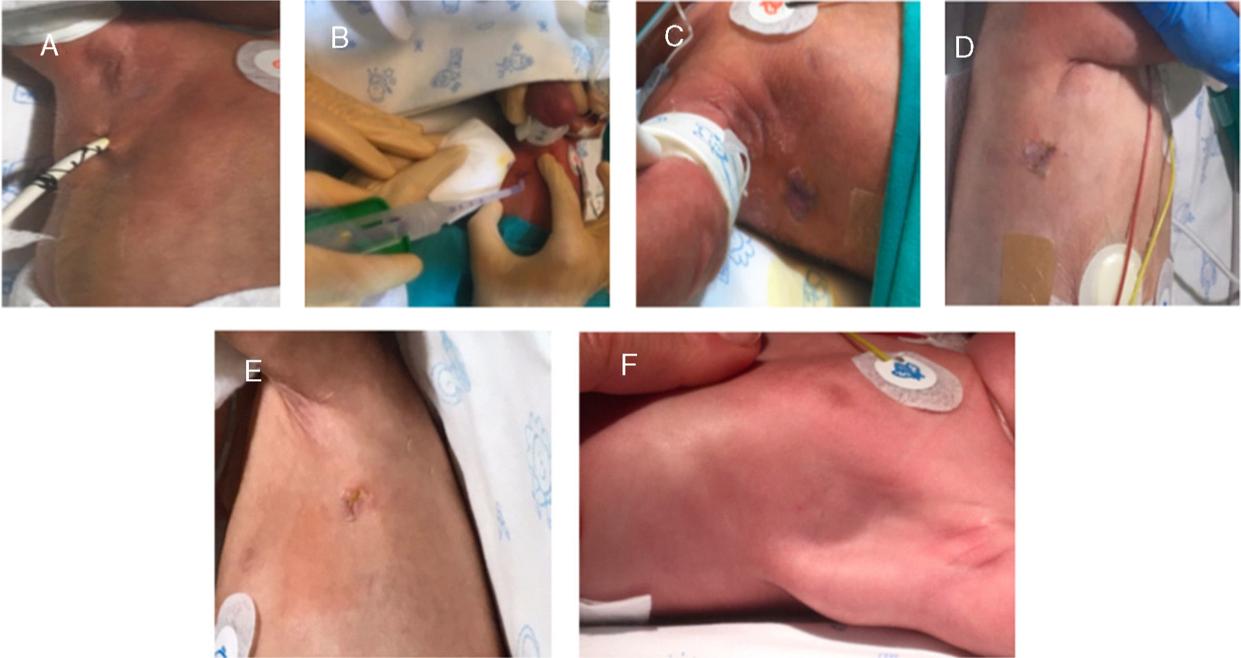 Figure 3 from Purse-String Suture for Round and Oval Defects: A Useful  Technique in Dermatologic Surgery | Semantic Scholar