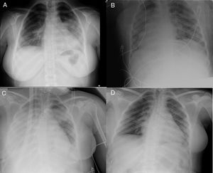Plain chest radiograph. A) Chest radiograph in emergency department of the regional hospital B) Chest radiograph at admission in ICU of regional hospital (prone position). C) Chest department at admission to ICU after transfer to referral hospital (day 0 of ECMO). D) Chest radiograph in inpatient ward of referral hospital (discharge day).