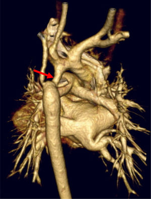 Three-dimensional reconstruction with computed tomography. Aortic arch coarctation with hypoplasia.