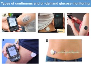 Types of continuous and on-demand glucose monitoring: Dexcom system, Novalab (A); Guardian system, Medtronic (B); Eversense system, Roche (C); FreeStyle system, Abbott (D); iPro blinded monitoring system, Medtronic (E).