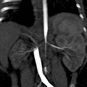 Computed tomography angiogram: stenosis of abd.ominal aorta abdominal and both renal arteries. Hypoplastic right kidney.