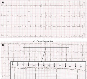 (A) Electrocardiogram recorded in the PICU at 24 h from admission. Narrow complex bradycardia with suspected high-grade atrioventricular block with 2:1 conduction. Blocked P waves “buried” in the T wave of the preceding heartbeat are difficult to discern. (B) Electrocardiogram with oesophageal probe (lead V1) recorded immediately following the one shown in Fig. 1A. Features consistent with high-grade 2:1 atrioventricular (AV) block. Atria (arrows) and ventricular activity seem dissociated, as the AV interval changes from beat to beat. Note: Since neonatal oesophageal electrodes were not available, we fitted an oesophageal lead as follows: we inserted a gastric tube previously rinsed with physiological saline, which served as the conductor, and without entirely removing the guide wire we connected it to the ECG lead and to the monitor. We slowly pulled the tube up towards the oesophagus while watching the ECG tracings to the point that atrial activity was detectable with the highest possible amplitude. The oesophageal tracings allow observation of amplified atrial activity and to analyse it independently from the QRS complex. This is very useful in the diagnosis of certain forms of supraventricular tachycardia or in case of conduction disorders when the AV conduction ratio is not clear in the surface ECG.