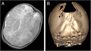 A) Infarction in both parietal lobes. B) Bilambdoid synostosis associated with foramina parietalia permagna.