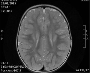Changes in white matter at age 2 years, patient 1.