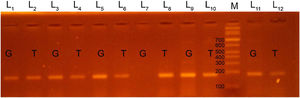 Polymerase chain reaction (PCR-ARMS) products of amplification of the EDN1 rs5370 locus, with identification of the GT genotype (lanes 1–6, 9–12) and the TT genotype (lanes 7, 8); lane M corresponds to the DNA marker.