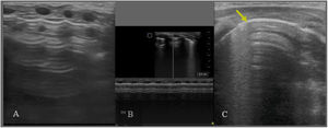Pneumothorax. (A) Anterior longitudinal plane. Absence of lung sliding, absence of B-lines and clearly defined A-lines. (B) M-mode. Absence of lung sliding. Stratosphere sign: pleural line and clearly defined equidistant A-lines. (C) Transverse plane, 4th–5th intercostal space. Lung point (LP): sonographic sign that marks the boundary between pneumothorax (absence of lung sliding) and any other lung pattern (lung sliding). On ultrasound, pneumothorax is considered mild-moderate if the LP is in the mid-clavicular line or anterior axillary line and severe if it is posterior to the mid-axillary line.