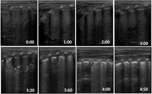 Normal clearance/aeration sequence in a neonate, starting from total collapse and with progressive aeration (appearance of pleural line and A-line and disappearance of B-lines in the first seconds of life).