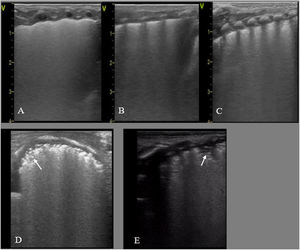 Respiratory distress syndrome. A, B and C: preterm neonate born at 30+2 wk. Urgent caesarean section without prenatal steroids. Lung ultrasound at admission: (A) Anterior plane: homogeneous alveolar-interstitial pattern without areas of aeration (no A-lines) and irregular pleural line, white lung. (B) Lateral plane, similar findings. (C) Posterior plane: alveolar-interstitial pattern with pleural thickening and subpleural consolidations in lung base. (D) Transverse plane: alveolar-interstitial pattern with subpleural consolidations (arrow). (E) Posterior longitudinal plane with alveolar-interstitial pattern with pleural thickening, subpleural consolidations and consolidation with air bronchogram (atelectasis) in 2 intercostal spaces (arrow).