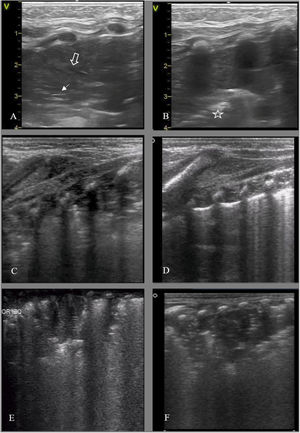 Detection of complications, forms of consolidation. A and B: Lung collapse/atelectasis due to endotracheal tube malposition. (A) Left anterior field: disappearance of pleural line with lung tissue hepatization and air bronchogram (hyperechoic, solid white arrow) and fluid (anechoic, hollow arrow). (B) Lateral field: absence of pleural line and hepatization, shred sign (hyperechoic border, boundary of collapsed lung/aerated lung) (star). (C) Preterm neonate born at 25+3 wk. Bronchopulmonary dysplasia. Consolidation/atelectasis in posterior field, disorganized bronchogram. (D) Same patient, follow-up ultrasound 2 h after change to prone position: resolution of consolidation. (E) Preterm neonate born at 23+5 wk, 50 h post birth, consolidation in left posterior field in the context of derecruitment. (F) Same patient at 35 days post birth, consolidation of homogeneous appearance in the clinical context compatible with ventilator-associated pneumonia.