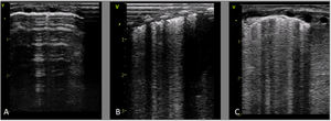 Sonographic evaluation in the first week of life in preterm neonate born at 25 weeks whose mother developed chorioamnionitis and was a carrier of Ureaplasma parvum in cervical fluid. (A) Normal pattern at 4 h post birth. (B) Day 3 post birth: alveolar-interstitial pattern with pleural thickening and fragmentation of the pleural line only in posterior fields. (C) Week 1 post birth: the same abnormal features are visible in every lung field. At this point, the respiratory support needs of the patient did not increase significantly, but starting from 2 weeks post birth she required aggressive scalation of ventilatory parameters and eventually developed severe bronchopulmonary dysplasia.