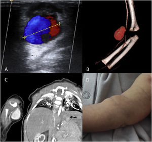 (A–C) Imaging studies of patients with pseudoaneurysms. (A) Doppler ultrasound. Yin–yang sign attributed to turbulent flow inside the arterial pseudoaneurysm. (B, C) CTA and 3D reconstruction of pseudoaneurysm dependent on the right brachial artery, with distal narrowing of vessel calibre. (D) Photograph of the patient with a pseudoaneurysm in the right brachial artery. Mass in right forearm 48 h after the traumatic puncture.