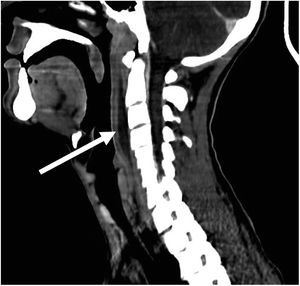 Laminar fluid collection measuring 7.5 × 3.3 × 0.9 cm in the retropharyngeal space extending from C2 to C6.